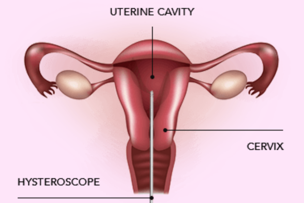 Hysteroscopy Procedure